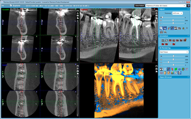 Planmeca ProMax 3D Max endodontic case