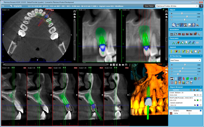 Planmeca ProMax 3D Max Implant planning