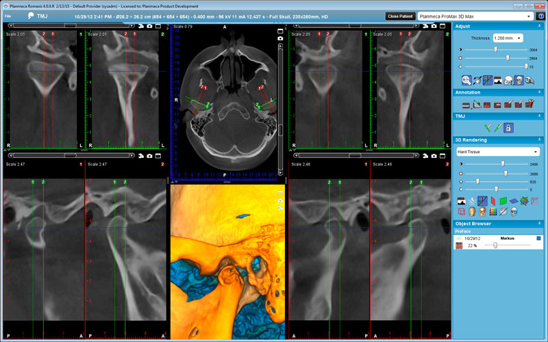 Planmeca ProMax 3D Max TMJ study