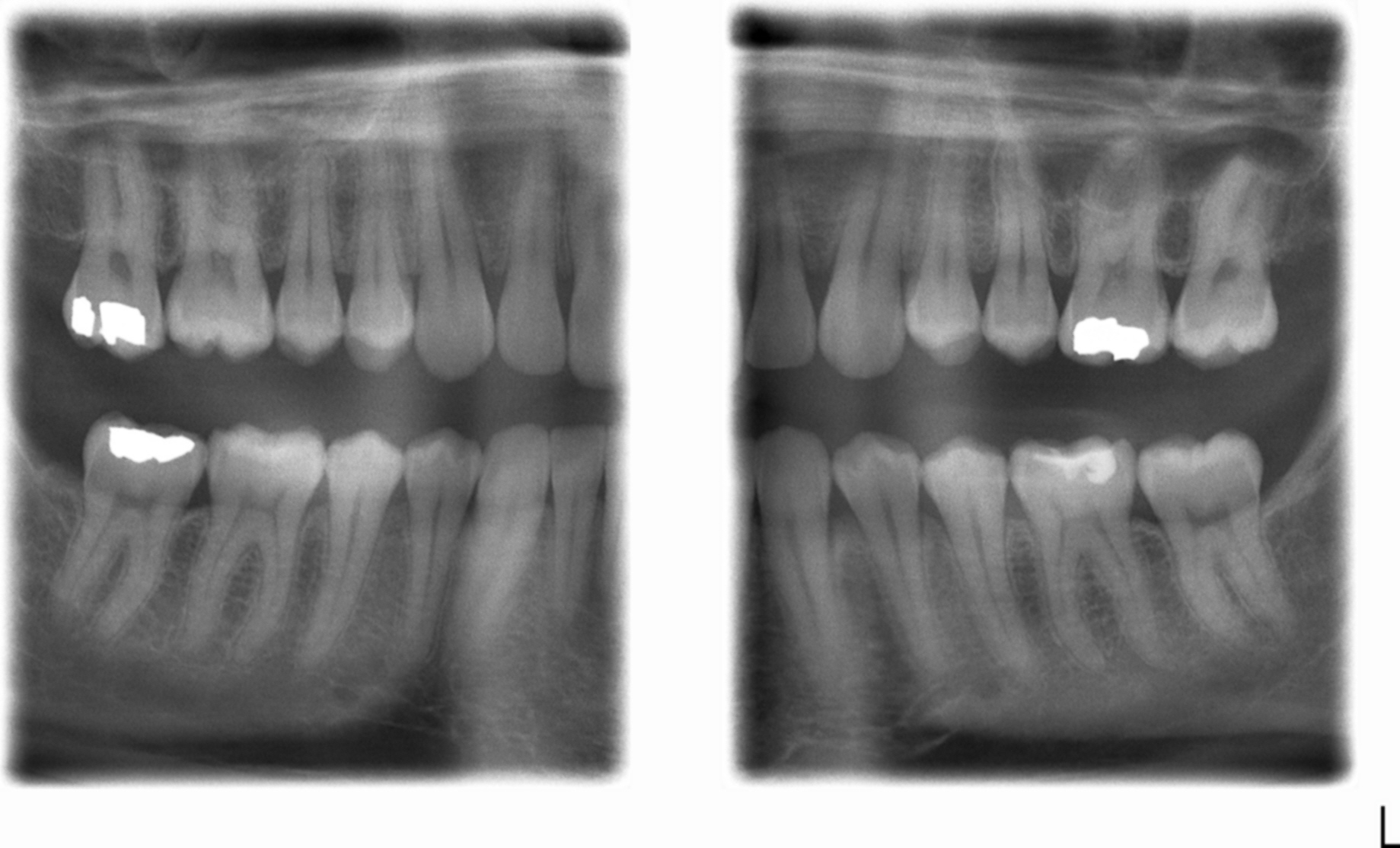 Pan/Bitewing Patient Studies