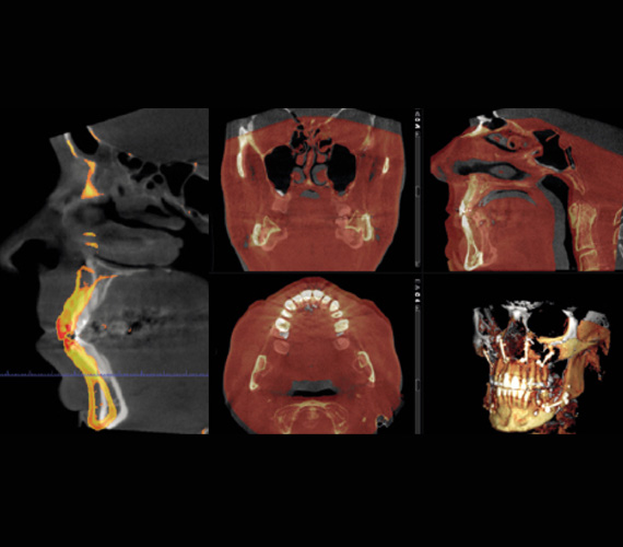 Planmeca Romexis superimposing CBCT images