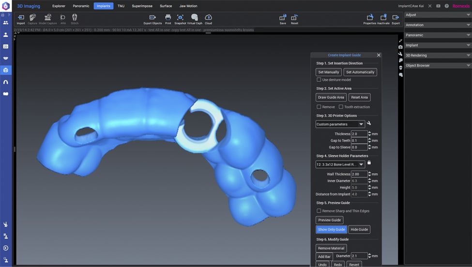 Planmeca Romexis implant workflow step 5