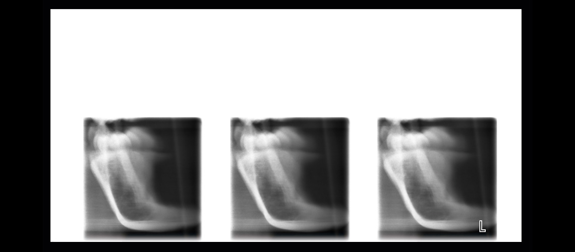 Planmeca ProOne® panoramic Xray unit
