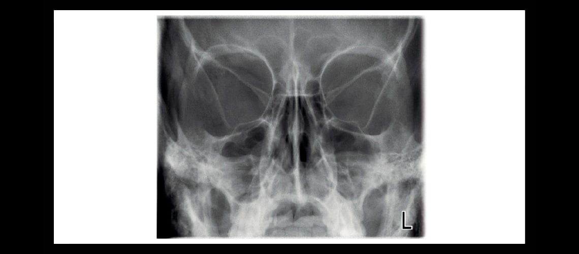 Lateral non-rotational sinus and PA non-rotational sinus