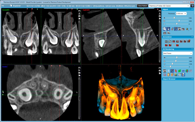 Impacted canine