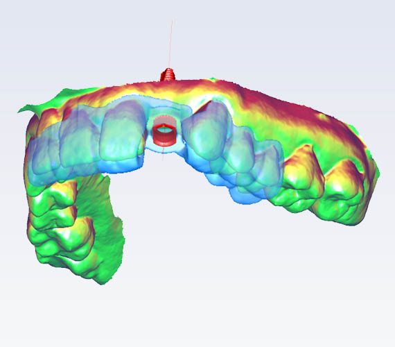 Planmeca Romexis 3D implant guide