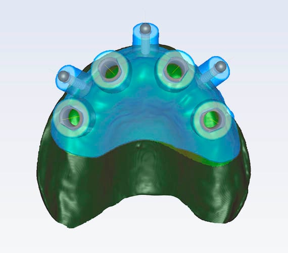 Planmeca Romexis 3D Mucosa support