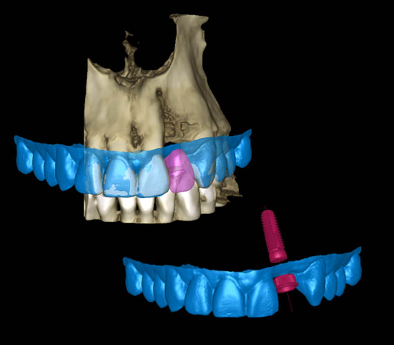 Planmeca Romexis 3D implant planning