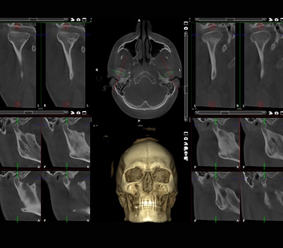 Planmeca Romexis TMJ views