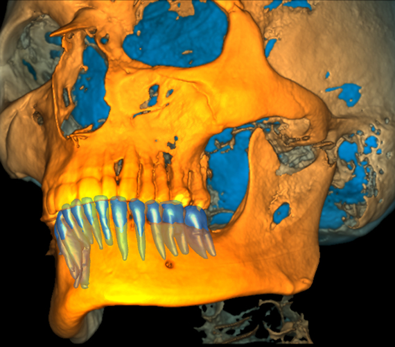 Planmeca Romexis segmenting