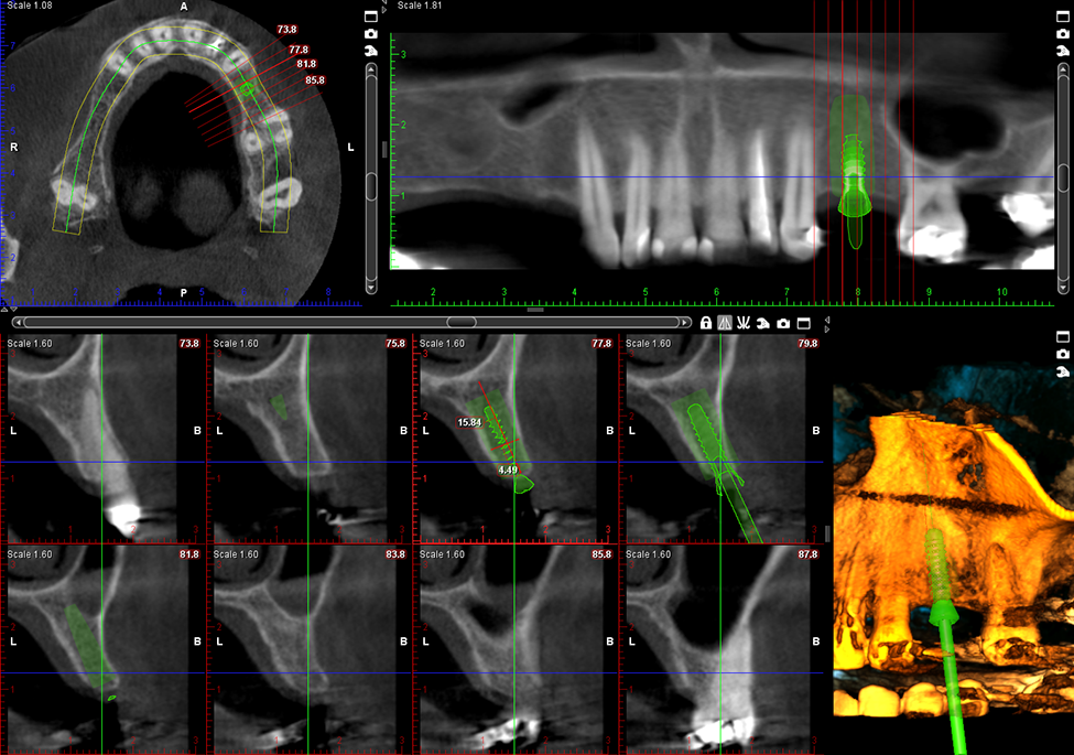 ProMax 3D Plus implant planning