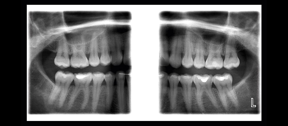 Planmeca ProOne® panoramic Xray unit
