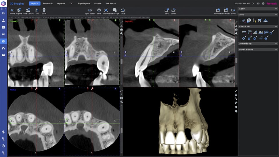 Planmeca Romexis implant workflow step 2 