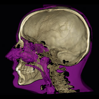 Visualise and measure airways and sinus volumes