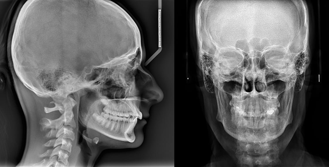 Planmeca ProCeph Lateral and PA projections