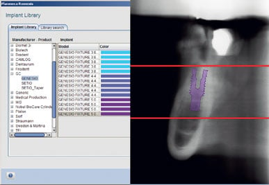 Advanced implant planning