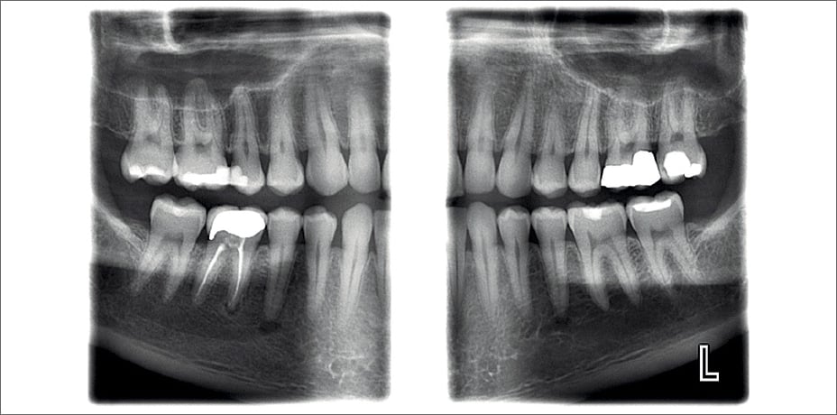 ProMax 2D clinical images bitewing