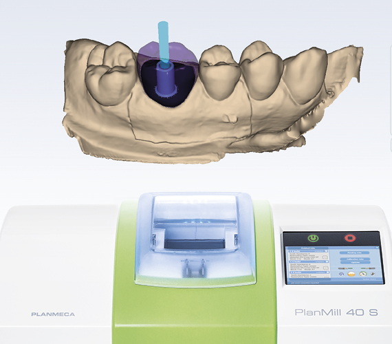 Planmeca PlanCAD Easy implant workflow for clinics