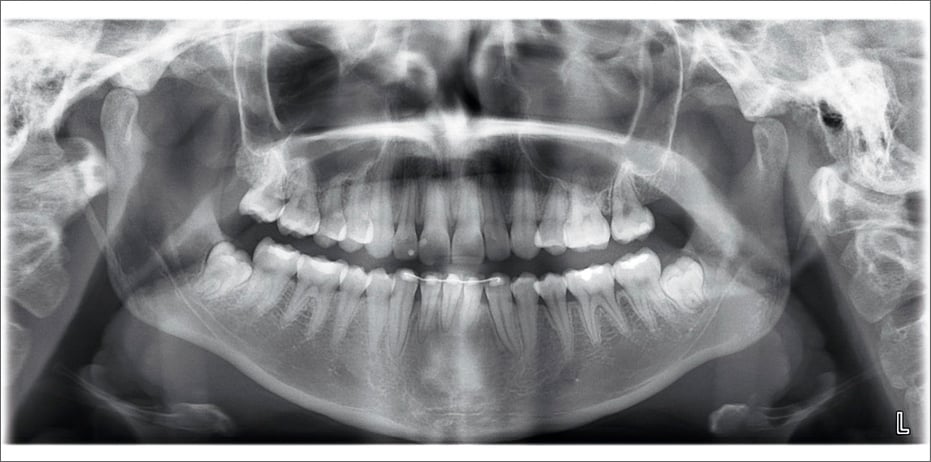 Planmeca ProOne standard panoramic
