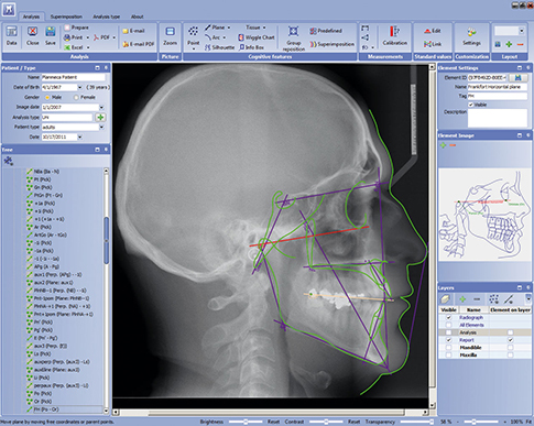 Planmeca Romexis cephalometric analysis module