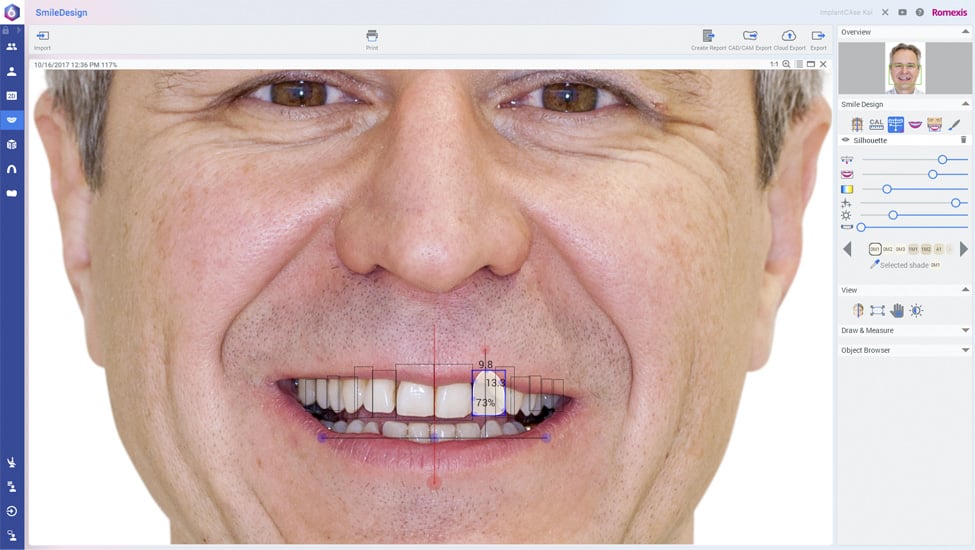 Planmeca Romexis implant workflow step 1