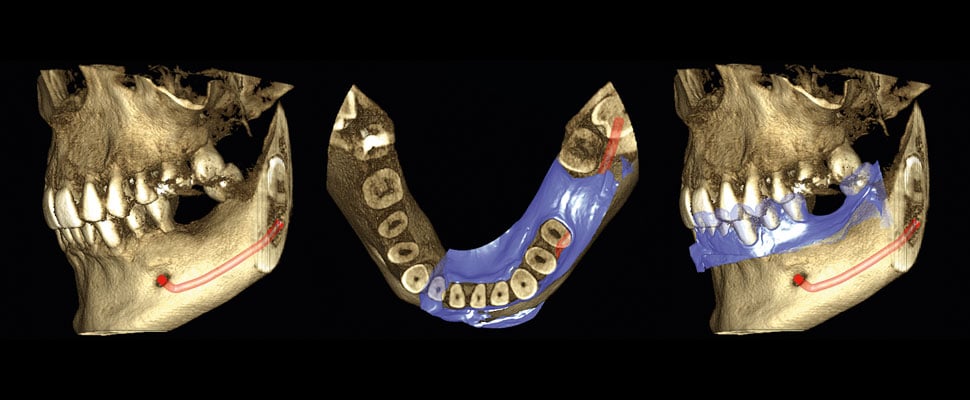 Mark the nerve on the CBCT image. Superimpose the 3D model scan on the CBCT image with Planmeca Romexis® software.