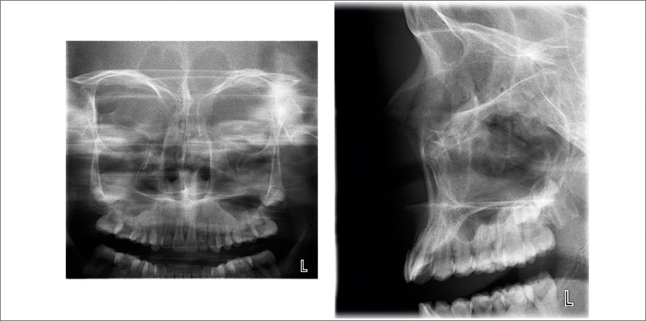 PA Sinus and Lateral rotational sinus