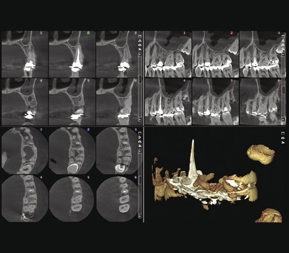 Planmeca ProMax 3D Classic endodontic imaging