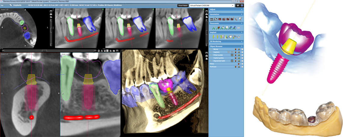 Planmeca Romexis implant planning module