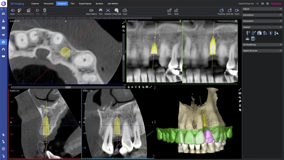 Planmeca Romexis implant workflow step 4