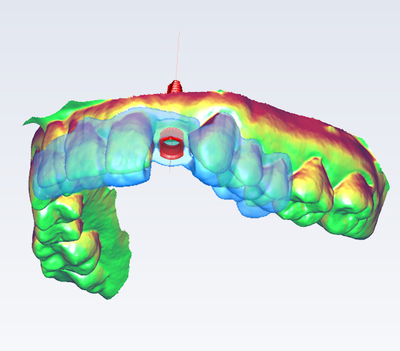 Planmeca PlanCAD Easy integrated part Romexis software