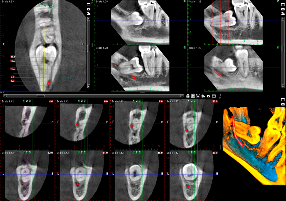 Promax 3D Classic wisdom tooth